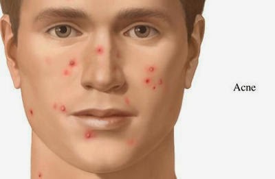 Various Types Of Acne And How To Identify Them