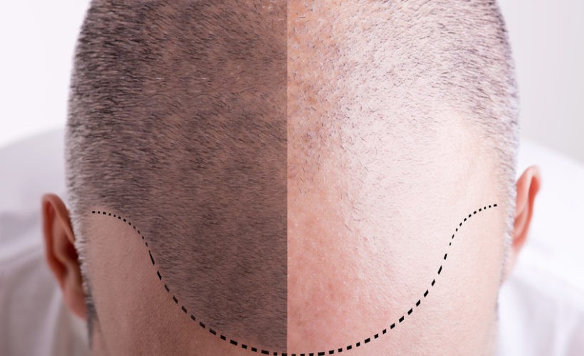 Benefits of Stem Cell Hair Loss Treatment