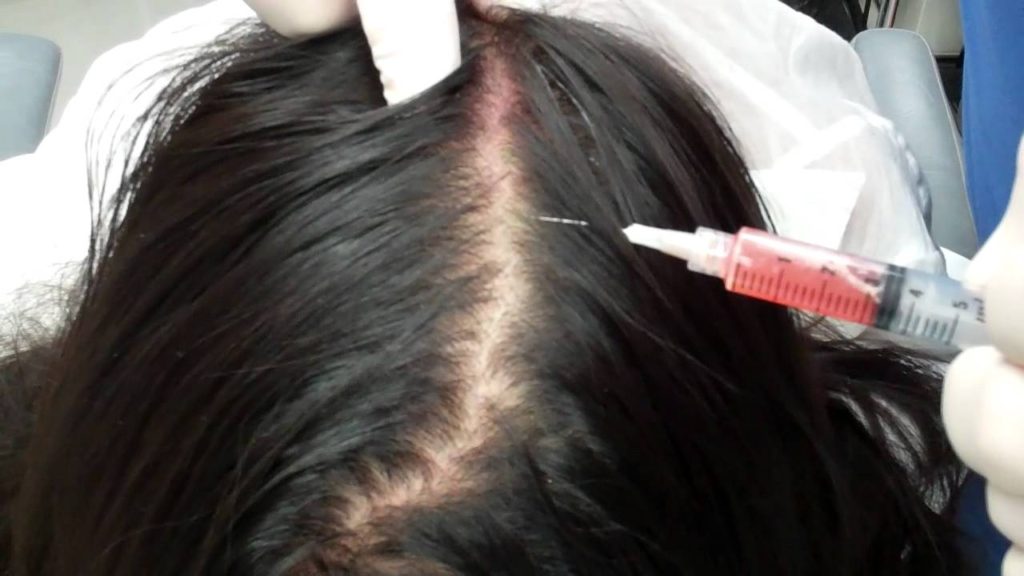 Benefits of Stem Cell Hair Loss Treatment