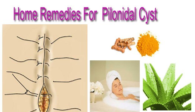 Home remedies for Pilonidal cysts