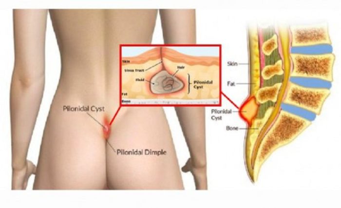 What is Pilonidal Disease and Ways to Treat it Naturally 700x427 - Home remedies for Pilonidal cysts