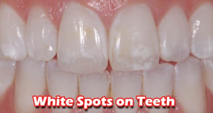 How to Get Rid Of  White Spots from Your Teeth