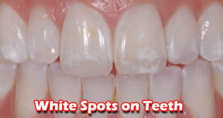 How to Get Rid Of  White Spots from Your Teeth