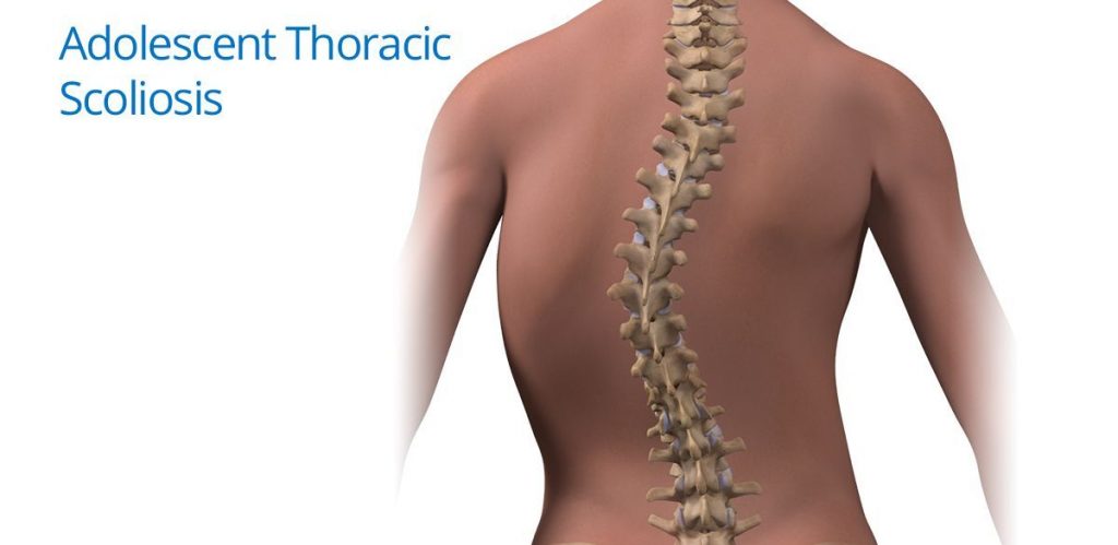 Home Remedies To Treat Scoliosis