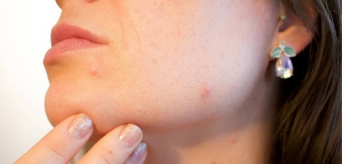 Best 8 Safest Ways To Treat Acne during Pregnancy