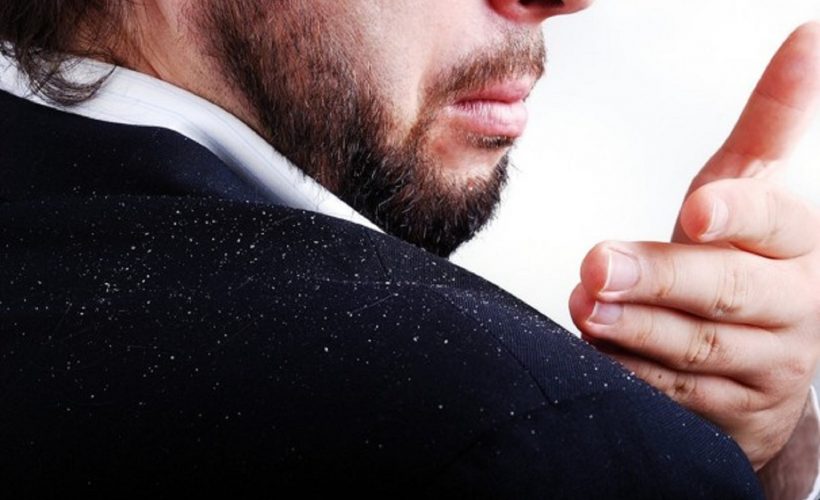 8 Effective Tips to Prevent Dandruff This Winter