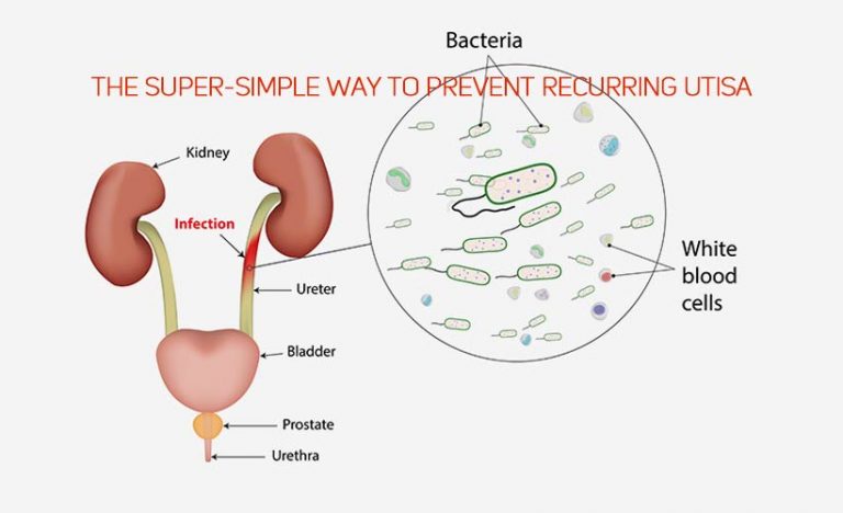 The Super-Simple Way to Prevent Recurring UTIs