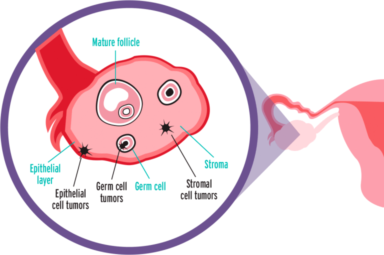 Knowing These Ovarian Cancer Facts Could Save Your Life