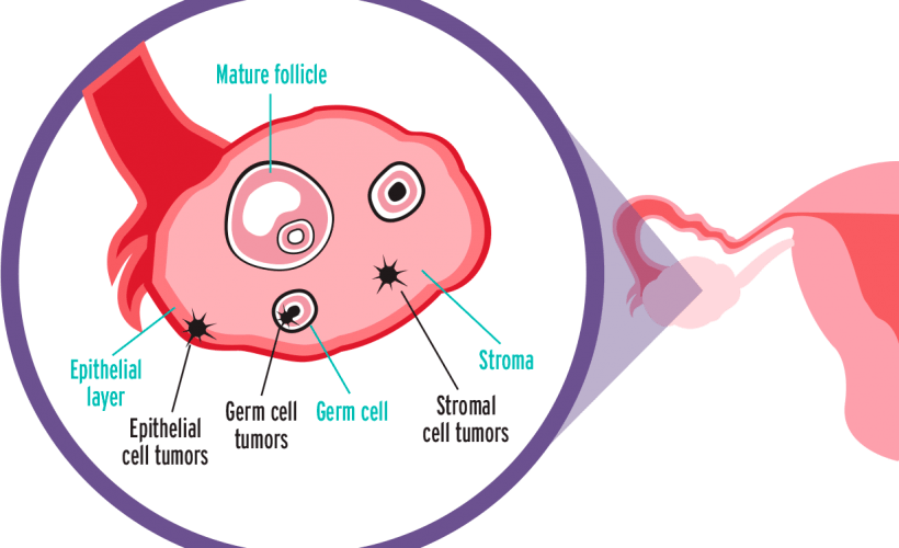 Knowing These Ovarian Cancer Facts Could Save Your Life Knowing These Ovarian Cancer Facts Could Save Your Life