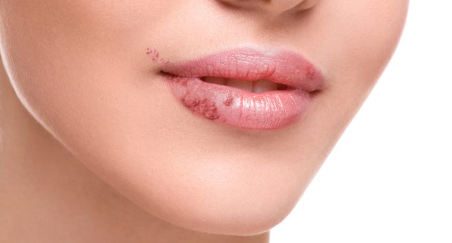 15 Easy Home Remedies for Herpes