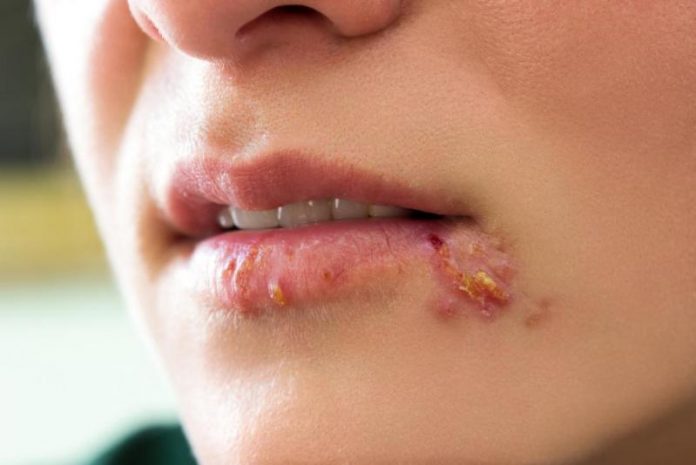 15 Easy Home Remedies for Herpes