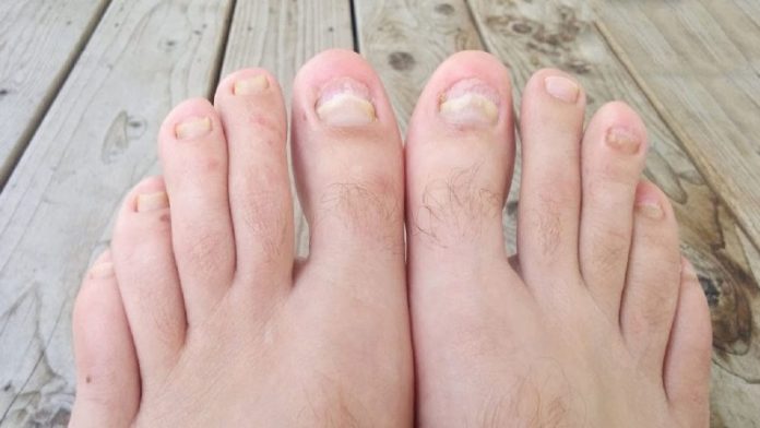 Top 10 Essential Oils for Toenail Fungus