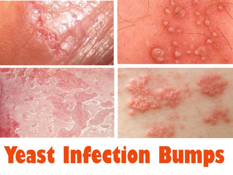 What is Yeast Infection - 15 Powerful Essential Oils for Yeast Infection