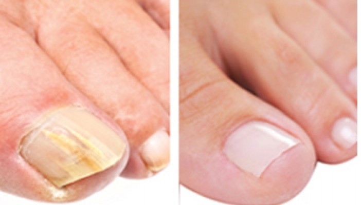 Top 10 Essential Oils for Toenail Fungus