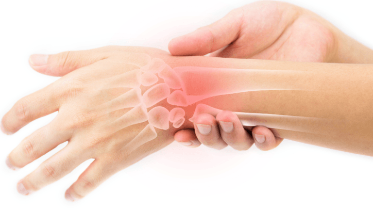 Carpal Tunnel Syndrome: Symptoms, Causes, Treatment