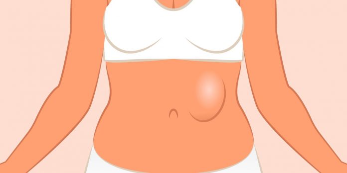 10 Effective Home Remedies for Hernia