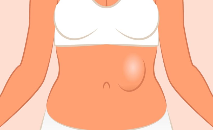 10 Effective Home Remedies for Hernia 10 Effective Home Remedies for Hernia