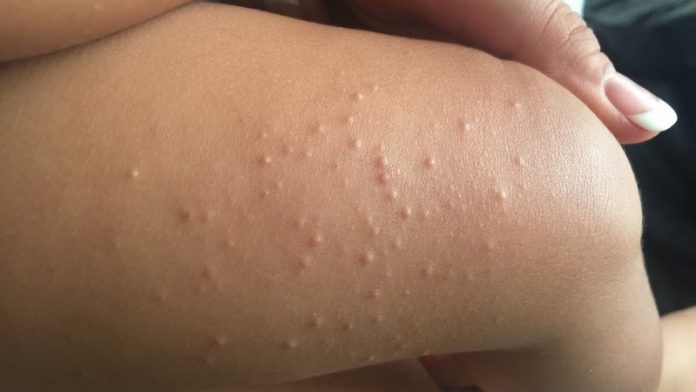 10 Best Home Remedies for Molluscum Contagiosum