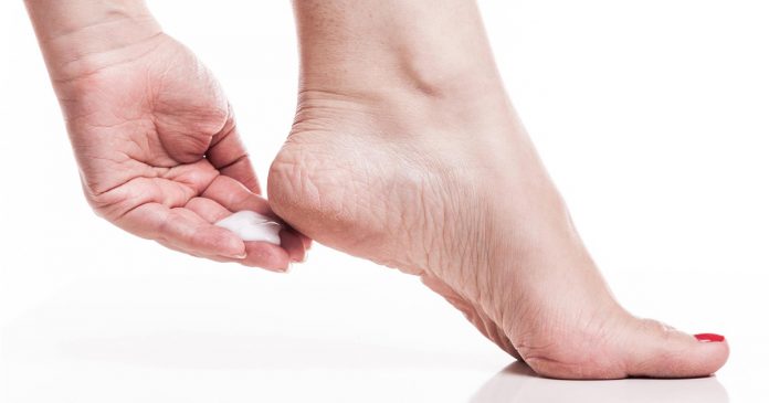 Some of the homemade remedies for Cracked Heels