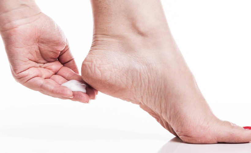 Some of the homemade remedies for Cracked Heels Some of the homemade remedies for Cracked Heels