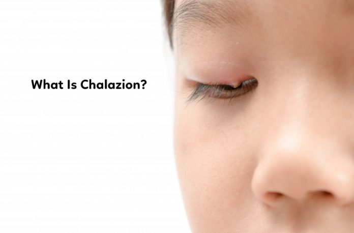 What Is Chalazion?
