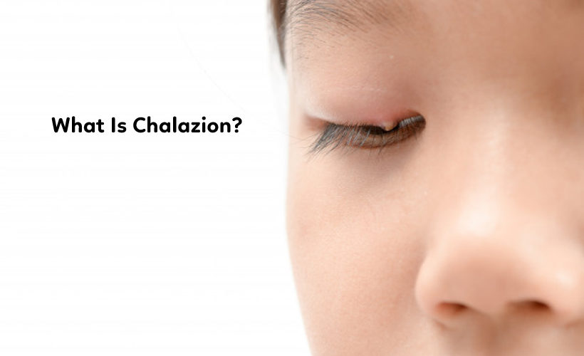 What Is Chalazion What Is Chalazion?