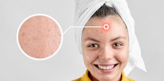 What Is Pregnancy Acne?
