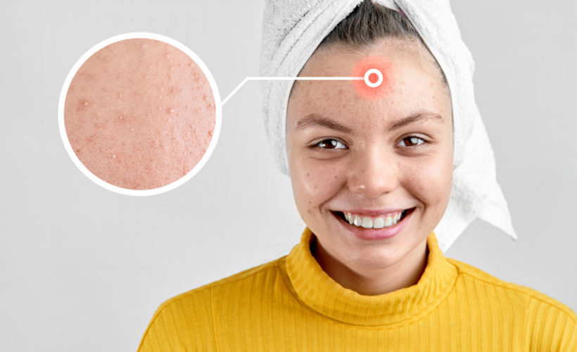 What Is Pregnancy Acne What Is Pregnancy Acne?
