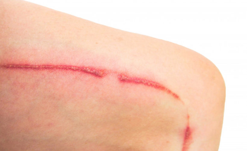 Home remedies to get rid of skin ulcer 1 Home remedies to get rid of skin ulcer