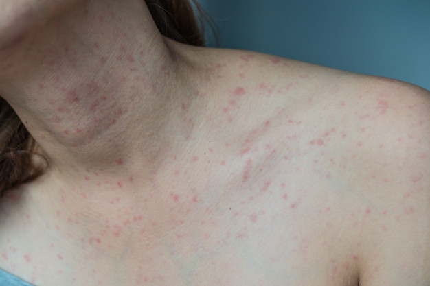 Natural Eczema Treatment: 13 Home Remedies for Eczema - Yabibo