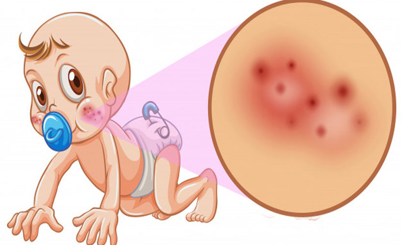9 Candida Symptoms and 3 Steps to Treat Them 9 Candida Symptoms and 3 Steps to Treat Them