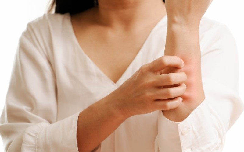 Eczema elimination diet and foods to eat Eczema elimination diet and foods to eat