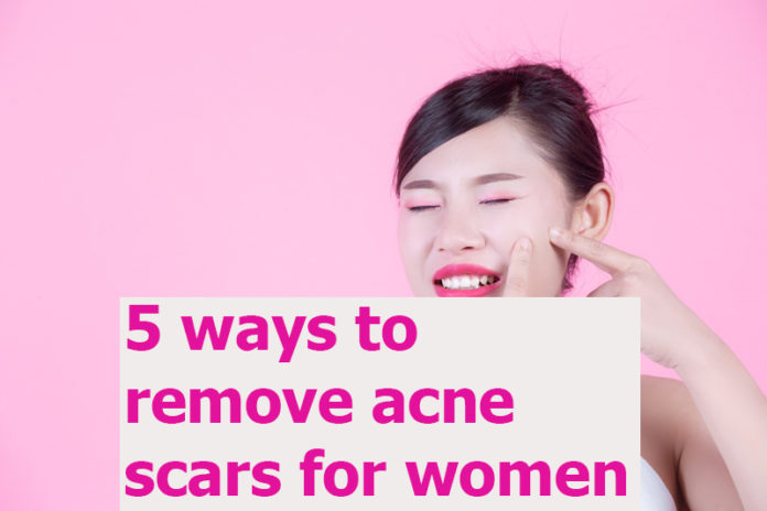 5 ways to remove acne scars for women