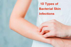 10 Types of Bacterial Skin Infections