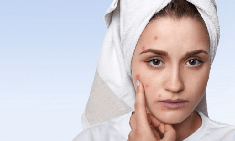 How To Get Rid of Heat Bumps on skin
