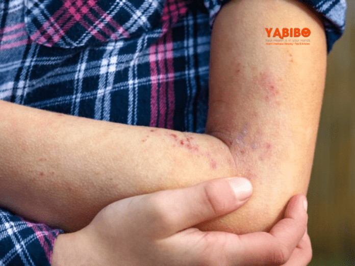 5 Home Remedies for Rashes to Try Today