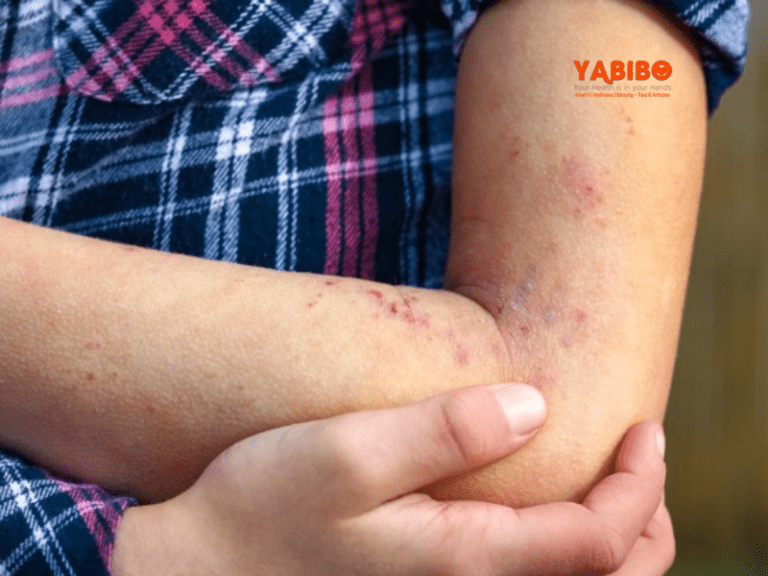 5 Home Remedies for Rashes to Try Today
