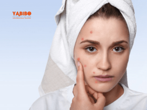 7 Natural Remedies to Cure One’s Monsoon Beauty Issues 