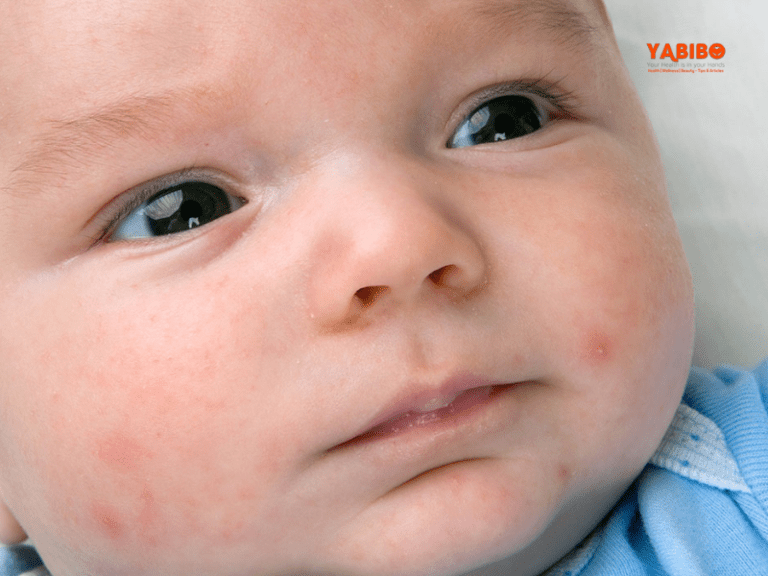 Toddler Acne Treatment Causes, Symptoms, Complications, Diagnosis