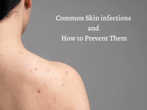 Common Skin infections and How to Prevent Them