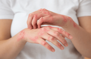Most common types of bacterial infections of the skin