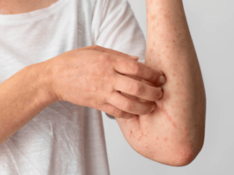 Most common types of bacterial infections of the skin