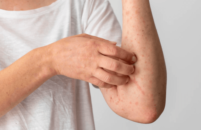 Most common types of bacterial infections of the skin