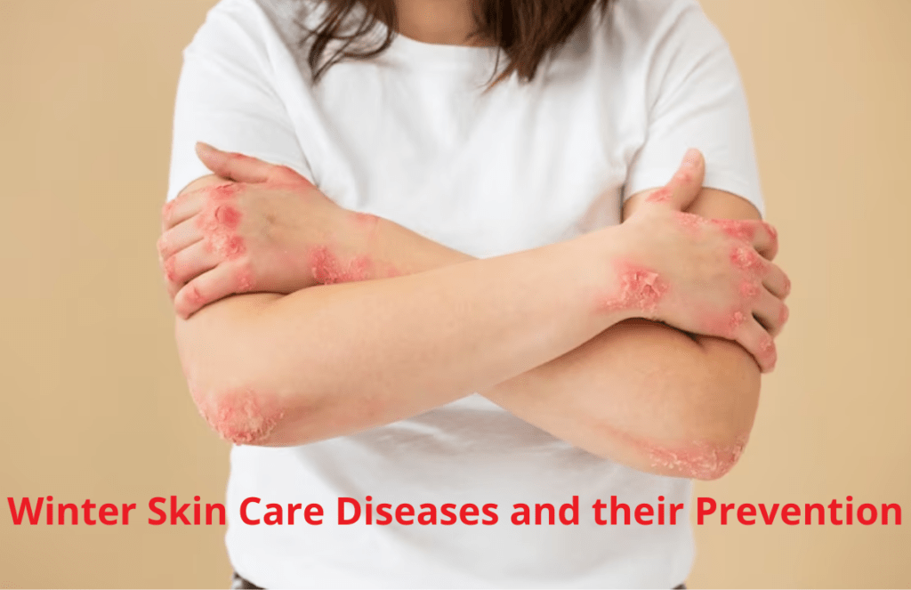 Winter Skin Care Diseases and their Prevention