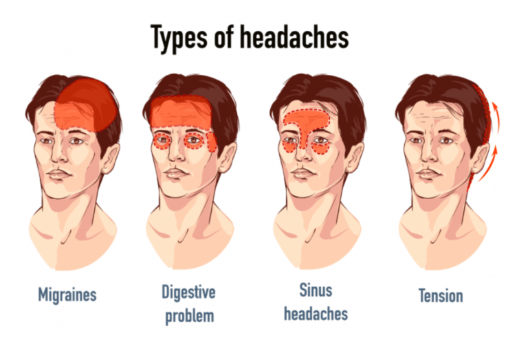 Symptoms and Signs of Different Headaches
