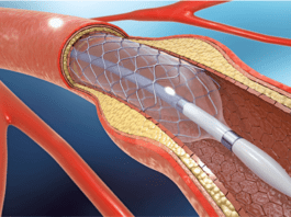 Stenting Surgery: It's functioning and effectiveness