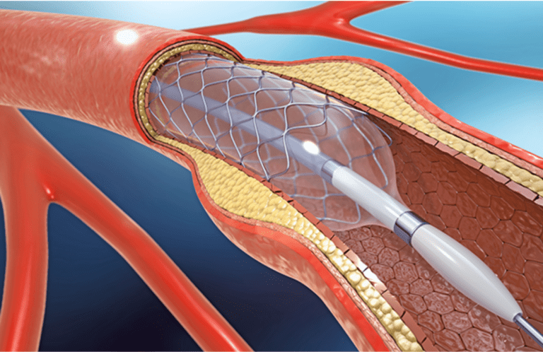 Stenting Surgery: It's functioning and effectiveness